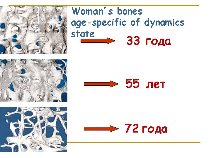 Woman´s bones age-specific of dynamics state 33 года 55 лет 72 года 
