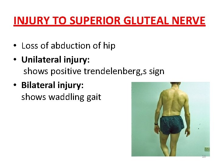 INJURY TO SUPERIOR GLUTEAL NERVE • Loss of abduction of hip • Unilateral injury: