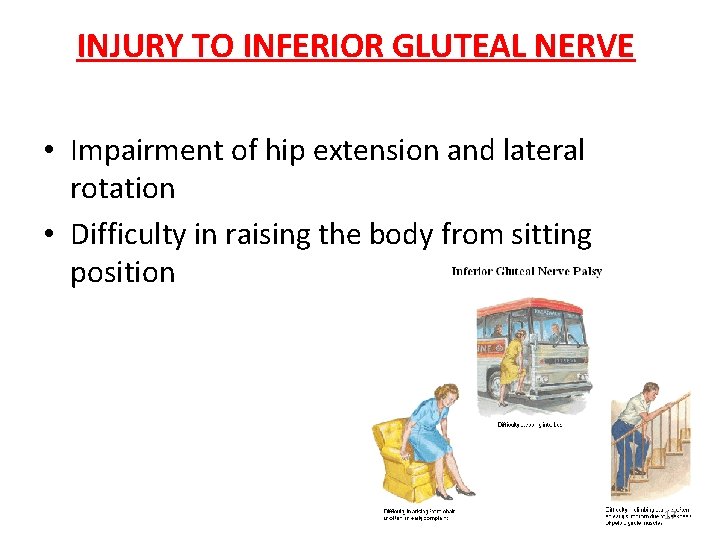 INJURY TO INFERIOR GLUTEAL NERVE • Impairment of hip extension and lateral rotation •