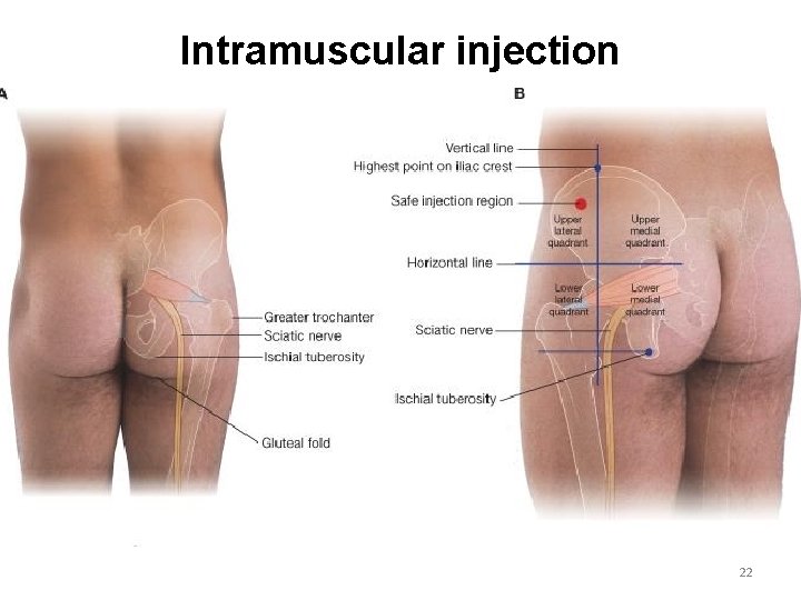 Intramuscular injection 22 