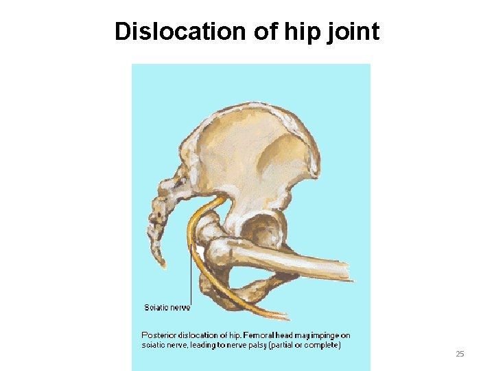 Dislocation of hip joint 25 