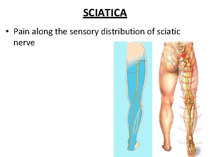 SCIATICA • Pain along the sensory distribution of sciatic nerve 27 