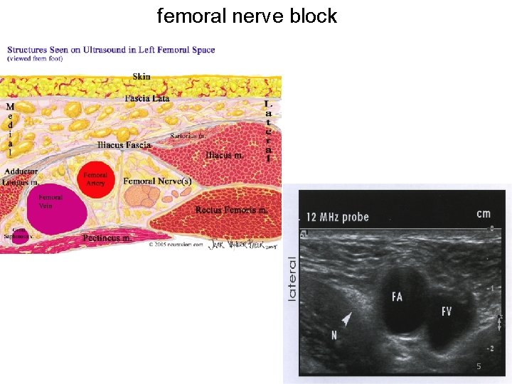 femoral nerve block 5 