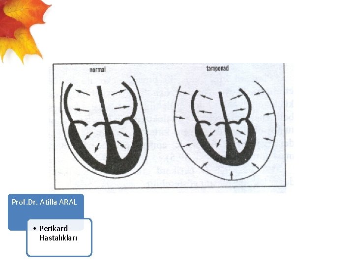  Prof. Dr. Atilla ARAL • Perikard Hastalıkları 