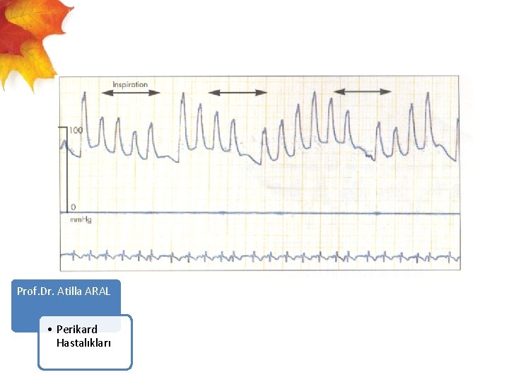  Prof. Dr. Atilla ARAL • Perikard Hastalıkları 