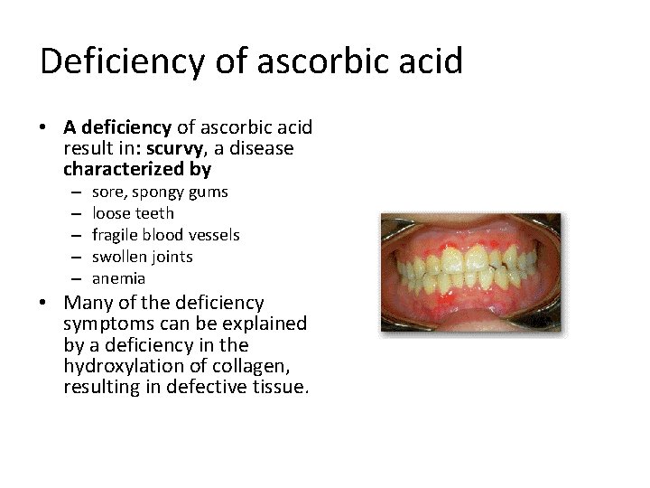 Deficiency of ascorbic acid • A deficiency of ascorbic acid result in: scurvy, a