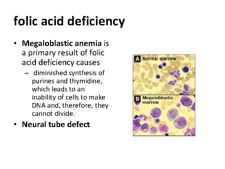 folic acid deficiency • Megaloblastic anemia is a primary result of folic acid deficiency