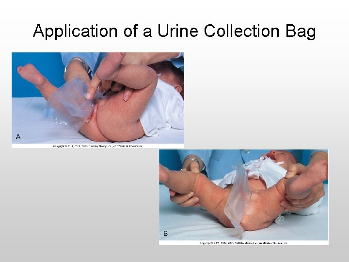 Application of a Urine Collection Bag 