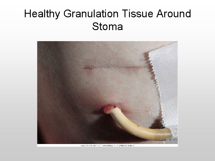 Healthy Granulation Tissue Around Stoma 