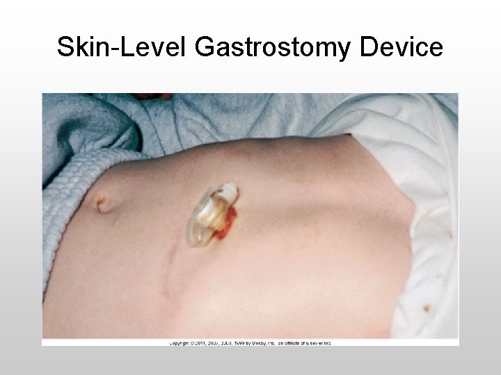 Skin-Level Gastrostomy Device 