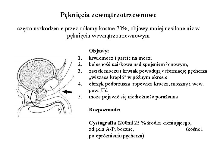 Pęknięcia zewnątrzotrzewnowe często uszkodzenie przez odłamy kostne 70%, objawy mniej nasilone niż w pęknięciu