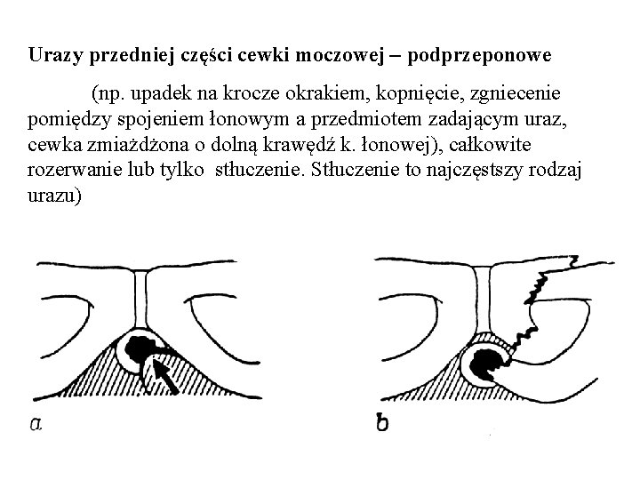 Urazy przedniej części cewki moczowej – podprzeponowe (np. upadek na krocze okrakiem, kopnięcie, zgniecenie