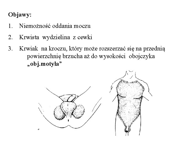 Objawy: 1. Niemożność oddania moczu 2. Krwista wydzielina z cewki 3. Krwiak na kroczu,