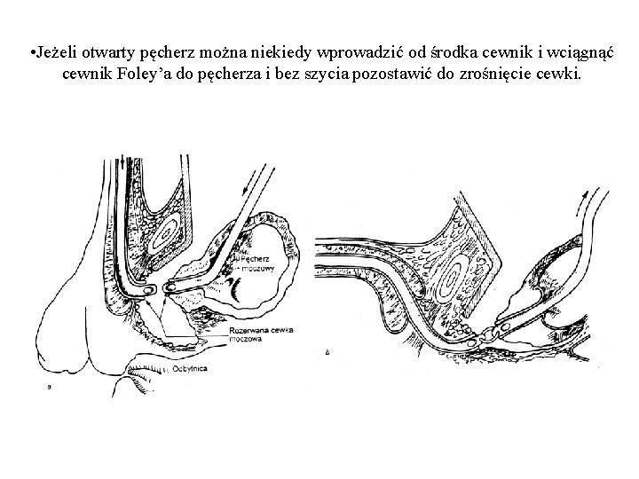  • Jeżeli otwarty pęcherz można niekiedy wprowadzić od środka cewnik i wciągnąć cewnik