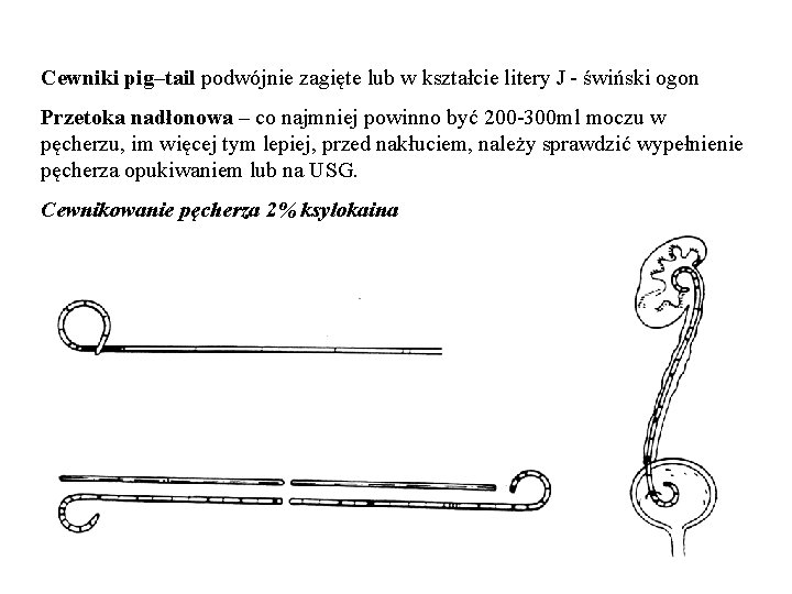 Cewniki pig–tail podwójnie zagięte lub w kształcie litery J - świński ogon Przetoka nadłonowa