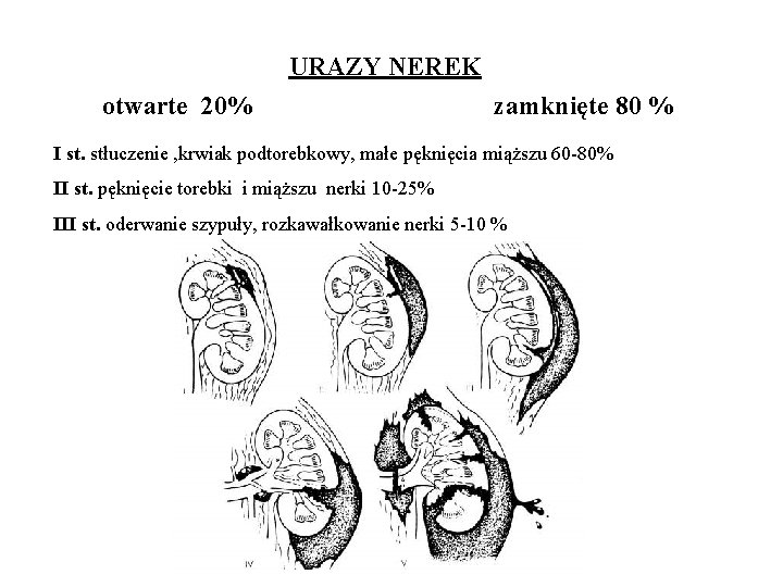 URAZY NEREK otwarte 20% zamknięte 80 % I st. stłuczenie , krwiak podtorebkowy, małe