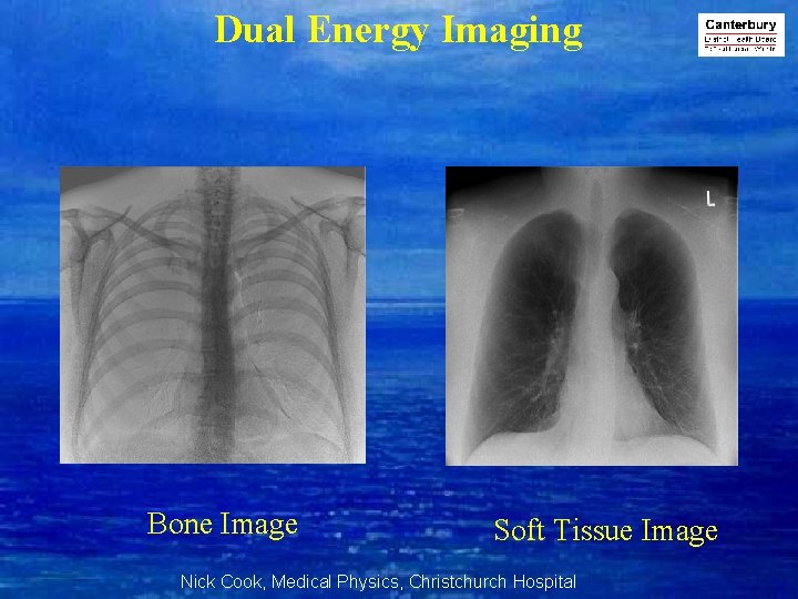 Dual Energy Imaging Bone Image Soft Tissue Image Nick Cook, Medical Physics, Christchurch Hospital