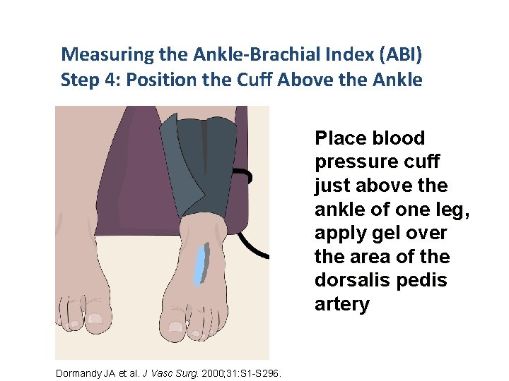 Measuring the Ankle-Brachial Index (ABI) Step 4: Position the Cuff Above the Ankle Place