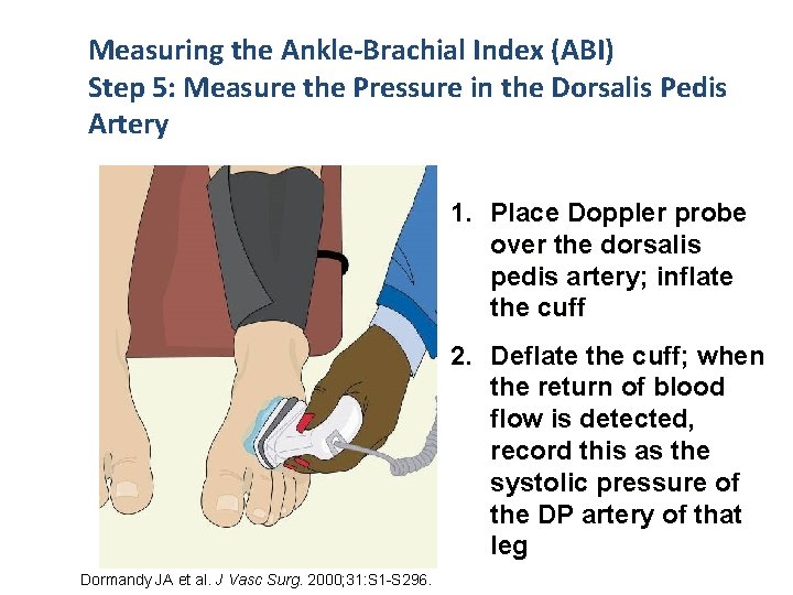 Measuring the Ankle-Brachial Index (ABI) Step 5: Measure the Pressure in the Dorsalis Pedis