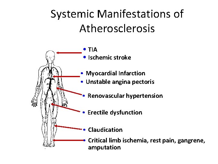 Systemic Manifestations of Atherosclerosis • TIA • Ischemic stroke • Myocardial Infarction • Unstable