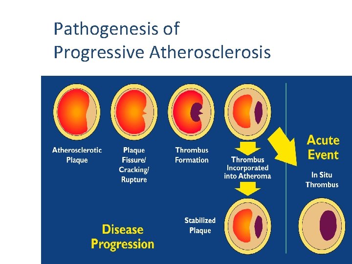Pathogenesis of Progressive Atherosclerosis 
