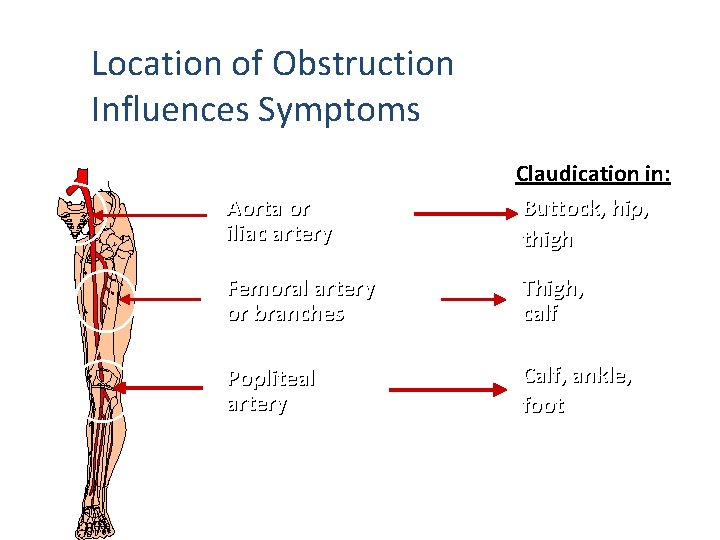 Location of Obstruction Influences Symptoms Obstruction in: Aorta or iliac artery Claudication in: Buttock,