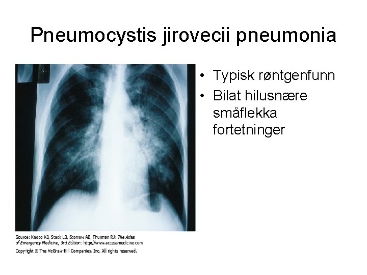 Pneumocystis jirovecii pneumonia • Typisk røntgenfunn • Bilat hilusnære småflekka fortetninger 