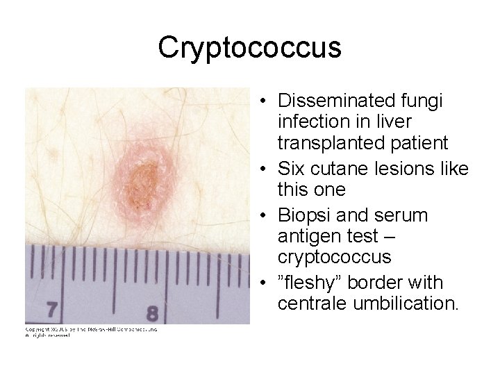 Cryptococcus • Disseminated fungi infection in liver transplanted patient • Six cutane lesions like