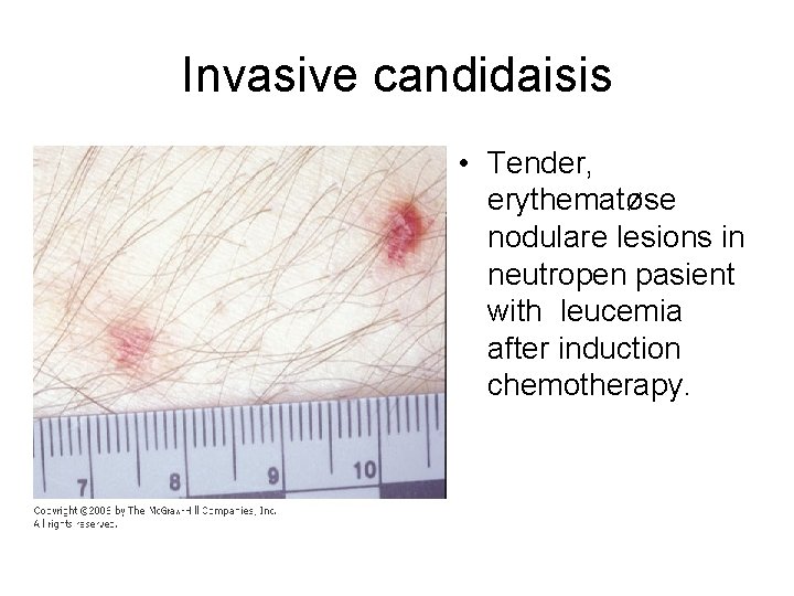 Invasive candidaisis • Tender, erythematøse nodulare lesions in neutropen pasient with leucemia after induction