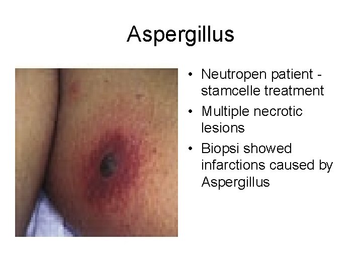 Aspergillus • Neutropen patient stamcelle treatment • Multiple necrotic lesions • Biopsi showed infarctions