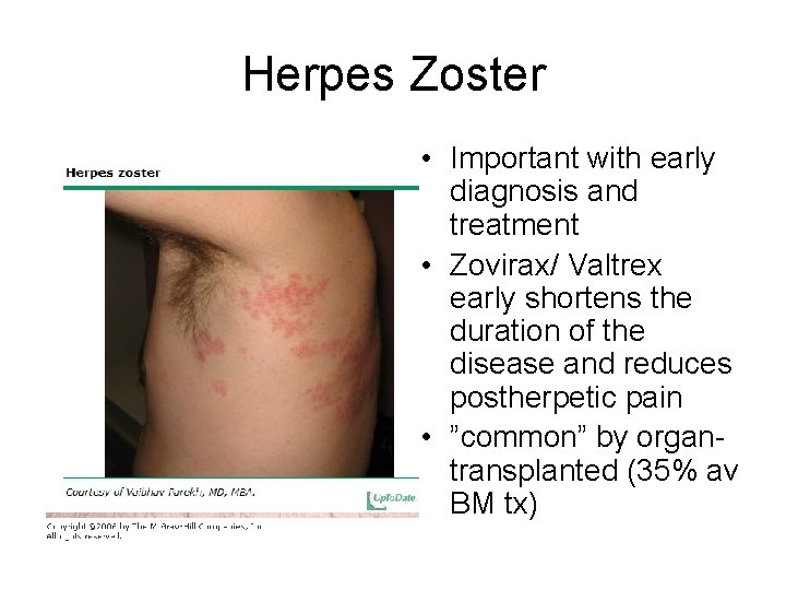 Herpes Zoster • Important with early diagnosis and treatment • Zovirax/ Valtrex early shortens