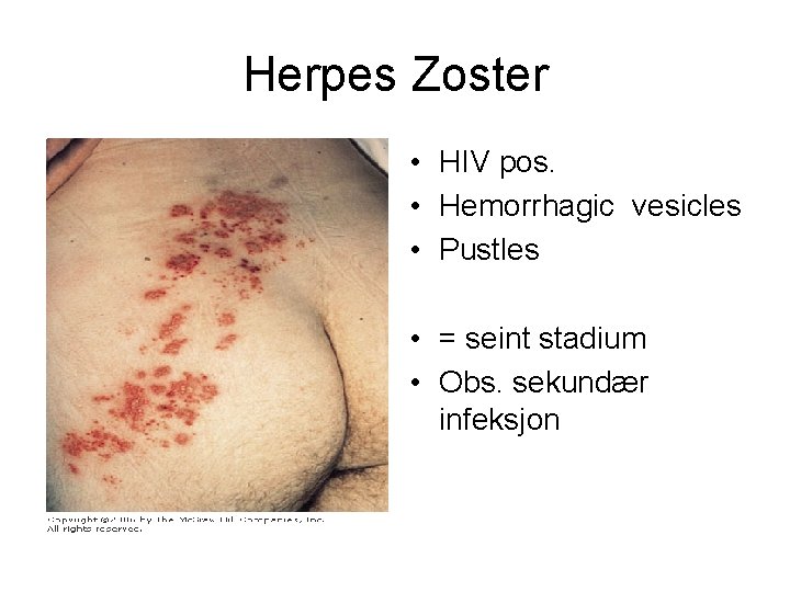 Herpes Zoster • HIV pos. • Hemorrhagic vesicles • Pustles • = seint stadium