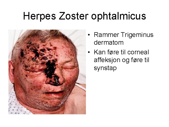Herpes Zoster ophtalmicus • Rammer Trigeminus dermatom • Kan føre til corneal affeksjon og