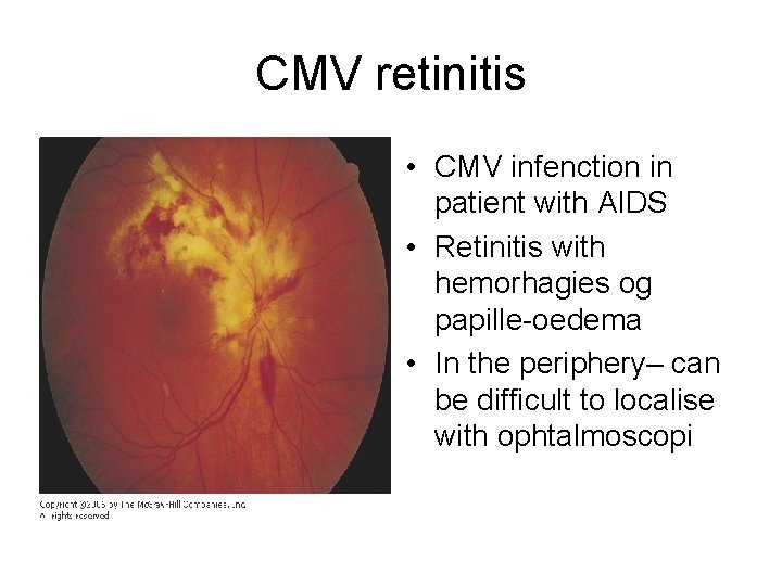 CMV retinitis • CMV infenction in patient with AIDS • Retinitis with hemorhagies og