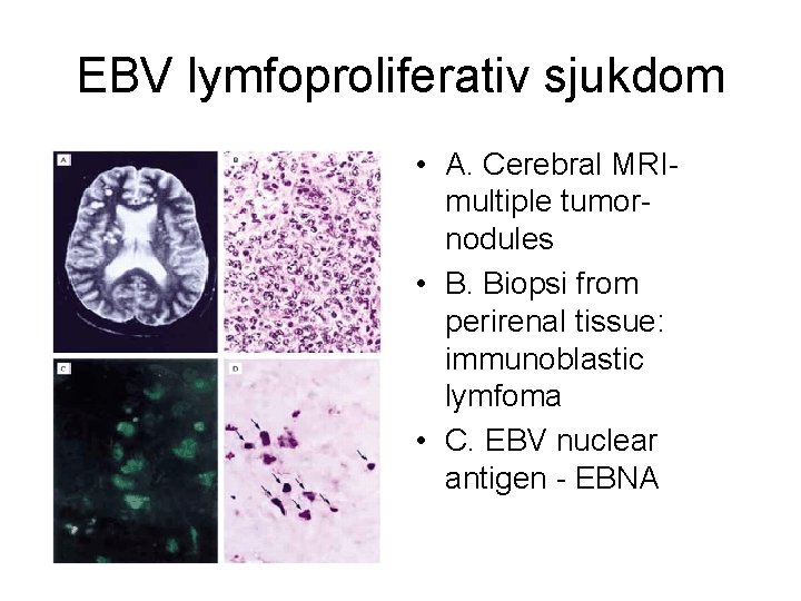 EBV lymfoproliferativ sjukdom • A. Cerebral MRImultiple tumornodules • B. Biopsi from perirenal tissue: