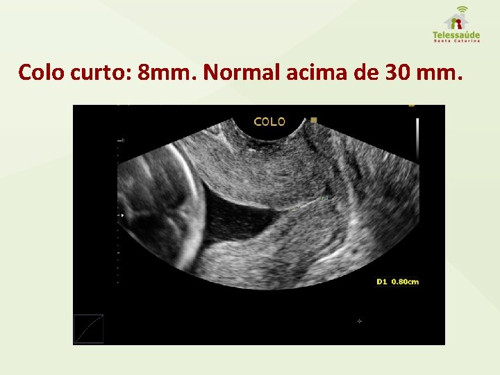 Colo curto: 8 mm. Normal acima de 30 mm. 