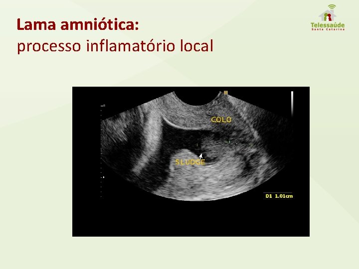 Lama amniótica: processo inflamatório local 