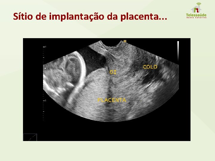 Sítio de implantação da placenta. . . 