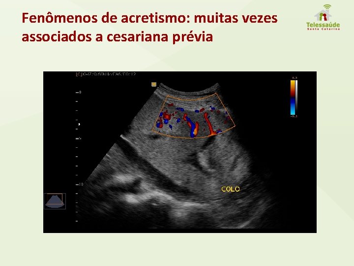 Fenômenos de acretismo: muitas vezes associados a cesariana prévia 