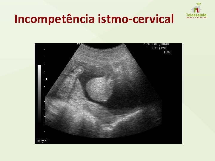 Incompetência istmo-cervical 