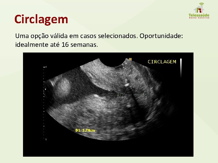 Circlagem Uma opção válida em casos selecionados. Oportunidade: idealmente até 16 semanas. 