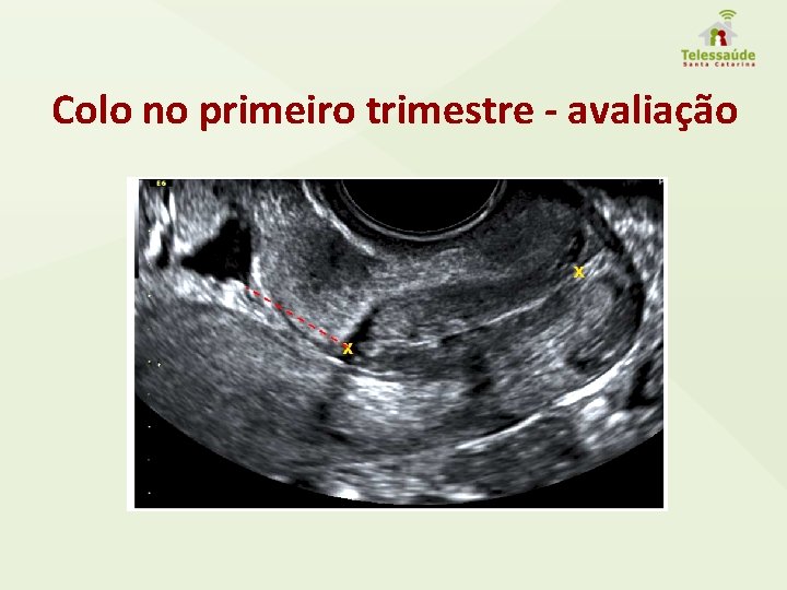 Colo no primeiro trimestre - avaliação 