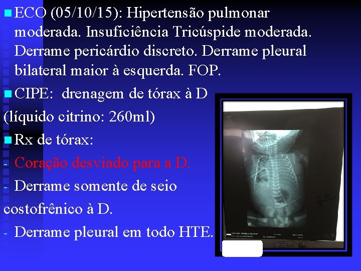 n ECO (05/10/15): Hipertensão pulmonar moderada. Insuficiência Tricúspide moderada. Derrame pericárdio discreto. Derrame pleural