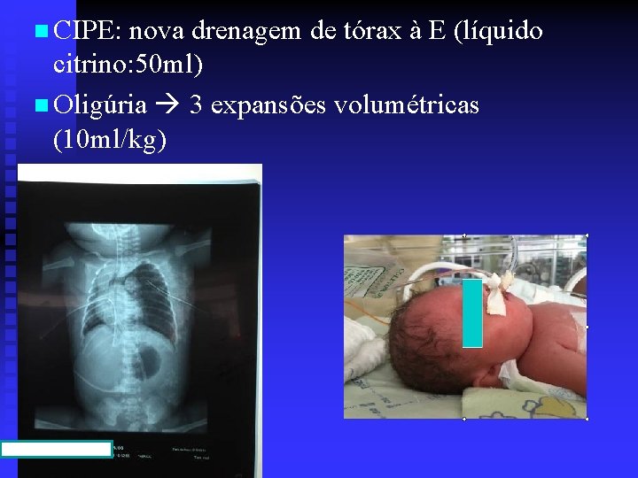 n CIPE: nova drenagem de tórax à E (líquido citrino: 50 ml) n Oligúria