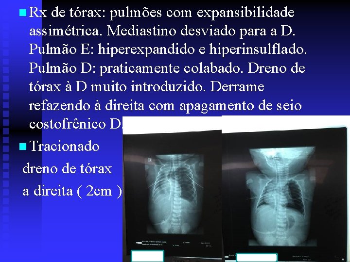 n Rx de tórax: pulmões com expansibilidade assimétrica. Mediastino desviado para a D. Pulmão