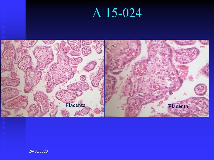 A 15 -024 Placenta 24/10/2020 Placenta 