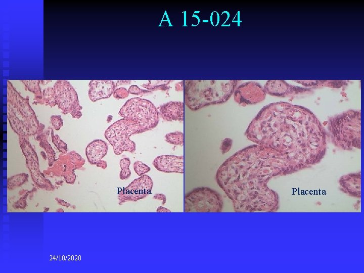 A 15 -024 Placenta 24/10/2020 Placenta 