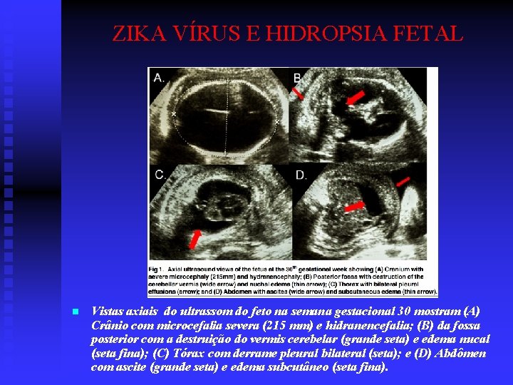 ZIKA VÍRUS E HIDROPSIA FETAL n Vistas axiais do ultrassom do feto na semana