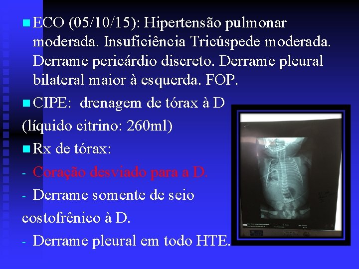 n ECO (05/10/15): Hipertensão pulmonar moderada. Insuficiência Tricúspede moderada. Derrame pericárdio discreto. Derrame pleural