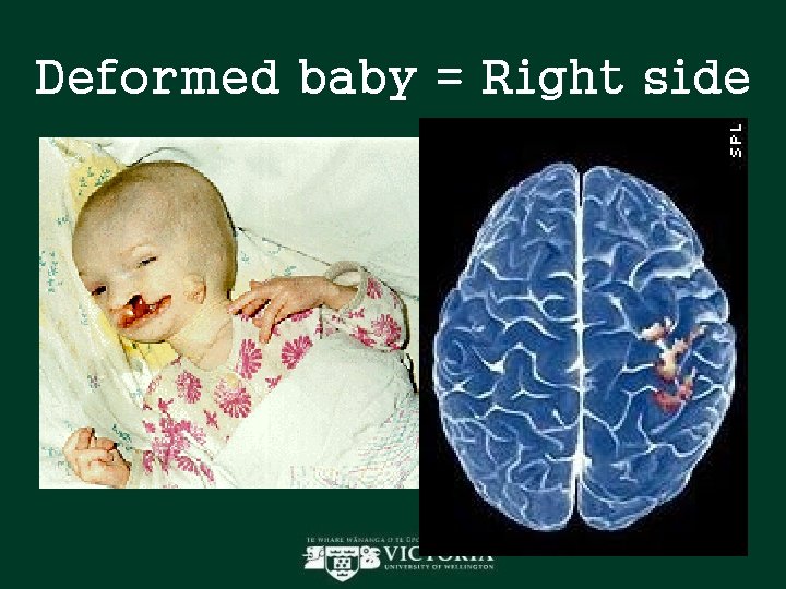 Deformed baby = Right side Deformed baby = Right side